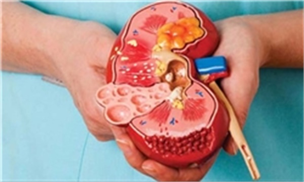 یک اورولوژیست: علائم عفونت کلیه‌ها را بشناسید