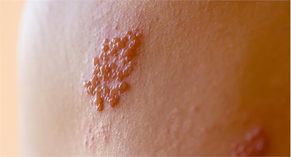 Herpes simplex virus