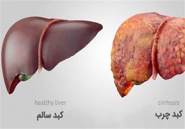 چه عواملی باعث ابتلا به "کبد چرب" می‌شود