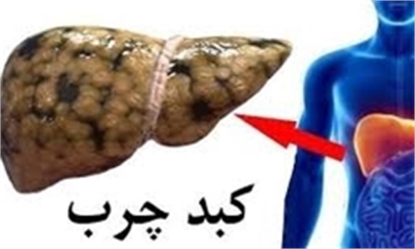 زنگ خطر کبد چرب به صدا در آمد/ خطرات اضافه وزن را جدی بگیرید